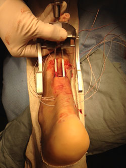 Photo of surgical repair of the patient's achilles tendon