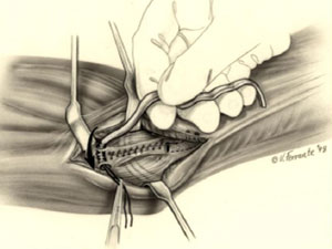 An illustration showing the insertion of the tendon graft in Tommy John surgery.