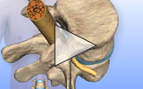 Lumbar spine herniated disc animation