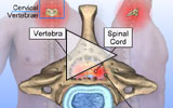 Cervical Spinal Stenosis Animation with Narration - click to launch