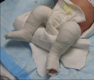 The third cast - The Achilles tendon is stretched, bringing the outer edge of the foot into a more normal position.
