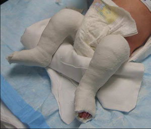 Ponseti Method For Correcting Clubfoot Overview For Parents