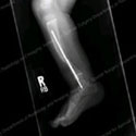 Post-op X-ray of a tibial fracture