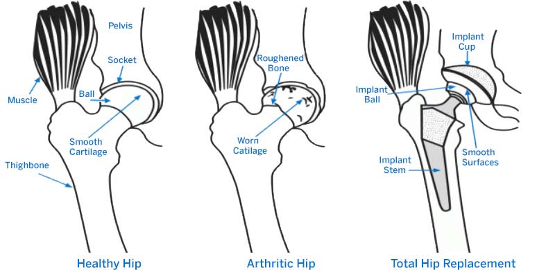 Graphic showing elements of a healthy hip, arthritic hip and total hip replacement.