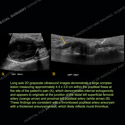 Image - Ultrasound of the Month Case 85 thumbnail