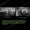 Image - Ultrasound of the Month Case 92 thumbnail