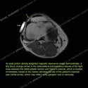Image - Ultrasound of the Month Case 94 thumbnail