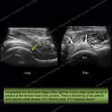 Image - Ultrasound of the Month Case 10 thumbnail
