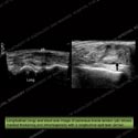 Image - Ultrasound of the Month Case 13 thumbnail