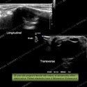 Image - Ultrasound of the Month Case 16 thumbnail