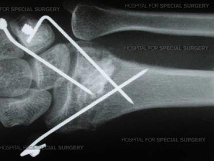 X-ray showing percutaneous fixation