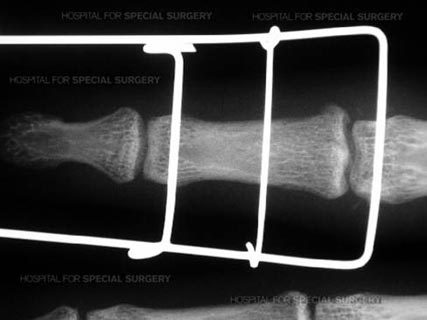 X-ray of external fixator for the proximal interpalaneal joint