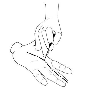 Illustration of percutaneous trigger finger release