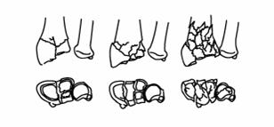Illustration of distal radius fractures