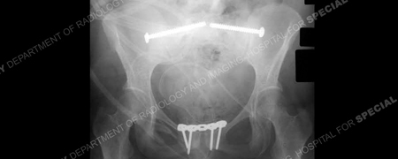 x-ray demonstrating anatomic reduction of symphysis pubis from a case example presented by the Orthopedic Trauma Service at Hospital for Special Surgery.