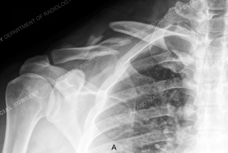 x-ray revleaing a right-sided displaced mid-shaft clavicle fracture from a case example from the orthopedic trauma service at hospital for special surgery.