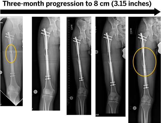 X-ray of an osteotomy of the femur and limb lengthening using percutaneous approach, with a three-month progression to 8 cm (3.25 inches).