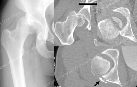 x-ray of right hip on presentation after motor vehicle accident from a case example of femoral head fracture presented by the orthopedic trauma service at Hospital for Special Surgery.
