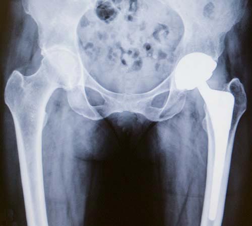 Playing Tennis After Knee Replacement or Hip Replacement