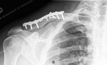 x-ray taken 10 weeks after clavicle fracture surgery from a case example provided by the orthopedic trauma service at Hospital for Special Surgery.