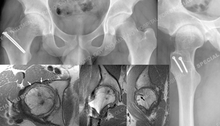 x-ray of hip 21 months after surgery, MRIs of demonstrating restoration of femoral head from a case example presented by the orthopedic trauma service at Hospital for Special Surgery.