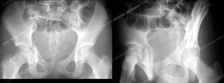 x-rays reveal acetabular fracture from a case example presented by the orthopedic trauma service at Hospital for Special Surgery.