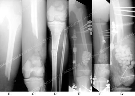 x-rays and radiographs of distal femur fracture with segmental bone defect from a case example presented by the Orthopedic Trauma Service at Hospital for Special Surgery.