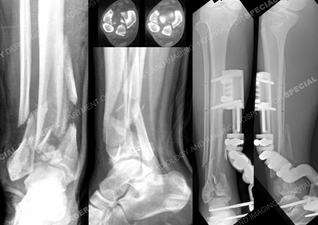 x-rays revealing distal tibia pilon fracture from orthopedic trauma service at Hospital for Special Surgery
