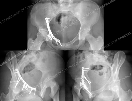 radiographs showing healed acetabular fracture from a case example presented by the orthopedic trauma service at Hospital for Special Surgery.