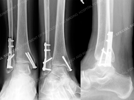 X-Rays taken at 9 months revealing a healed ankle fracture, from the Orthopedic Trauma Service at Hospital for Special Surgery.
