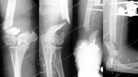 x-rays revealing a left-sided bicondylar distal humerus fracture from a Case Example from the Orthopedic Trauma Service at Hospital for Special Surgery.