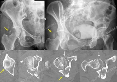 x-rays revealing right-sided pipkin IV femoral head fracture from a case example presented by the Orthopedic Trauma Service at Hospital for Special Surgery.