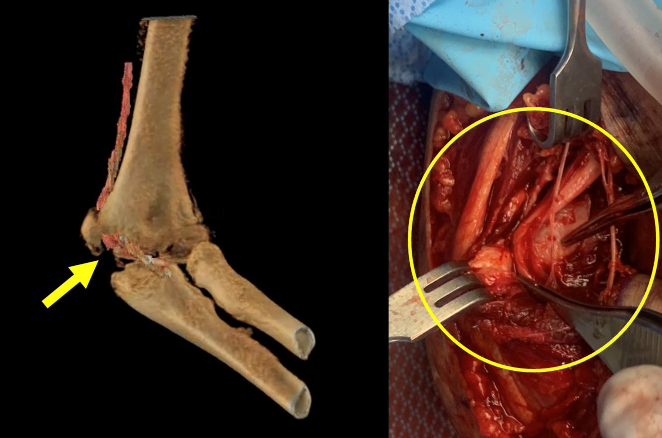 Median Nerve Entrapment at Medial Epicondylar Fracture Site of Elbow