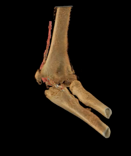 3D visualization of bone (beige) and entrapped medium nerve (red) at the epicondylar fracture site of the elbow