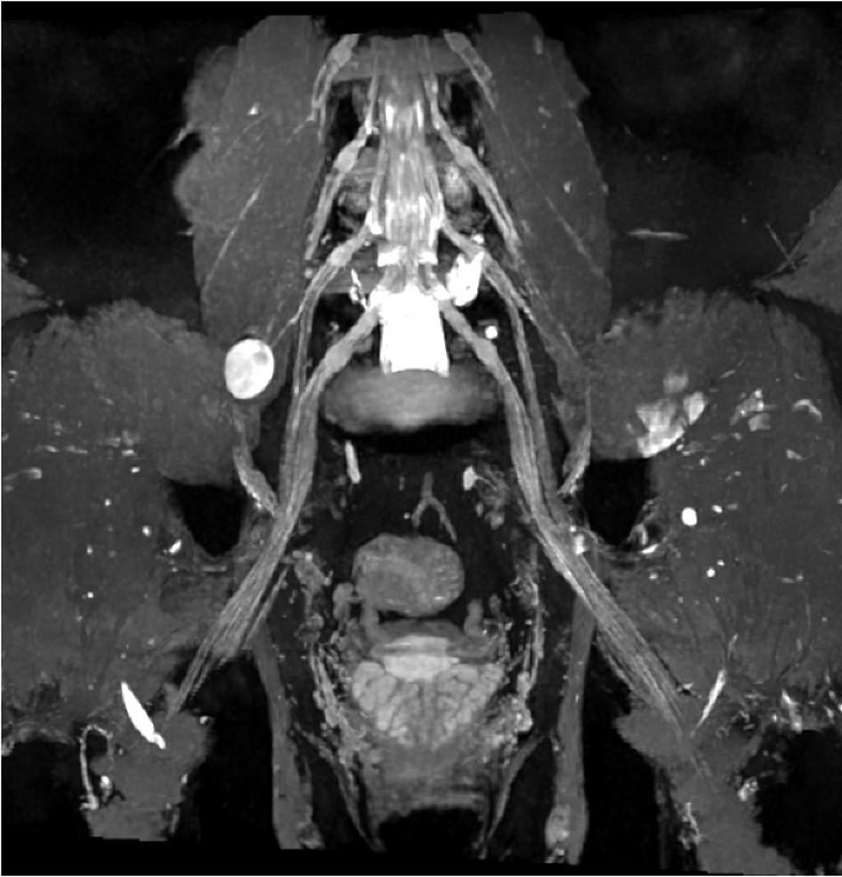 3D MR Neurography (MRN): Peripheral Neve Sheath Tumor Arising from Right Femoral Nerve of Lumbosacral Plexus (Pelvis)