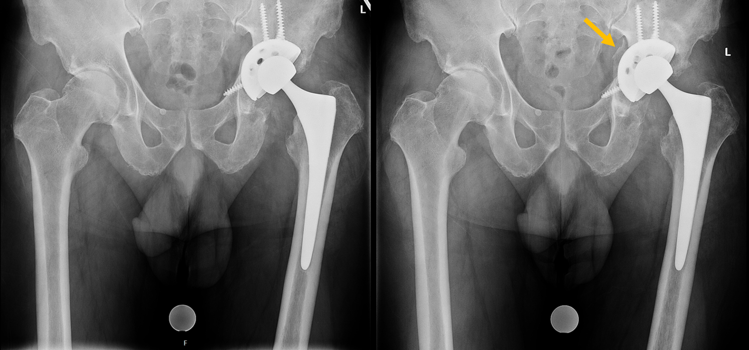 X-rays showing a failed left total hip arthroplasty. There was a fracture of the anterior acetabular column and loosening of the acetabular component. The patient required revision surgery.