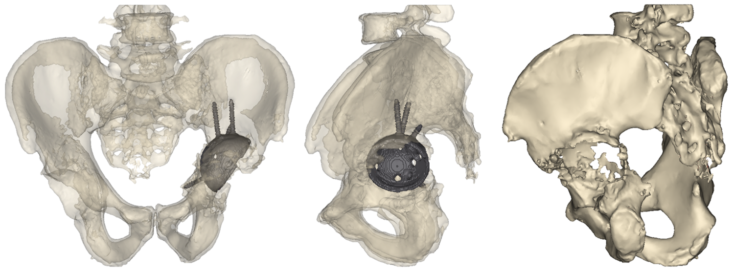 3D reconstruction from CT scan images show the location of indwelling hardware and the extensive acetabular defect.