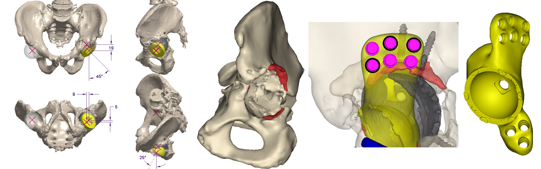 The Device Development team works with the surgeon and outside manufacturers to develop a patient-specific flanged acetabular component to treat the patient’s unique defect.