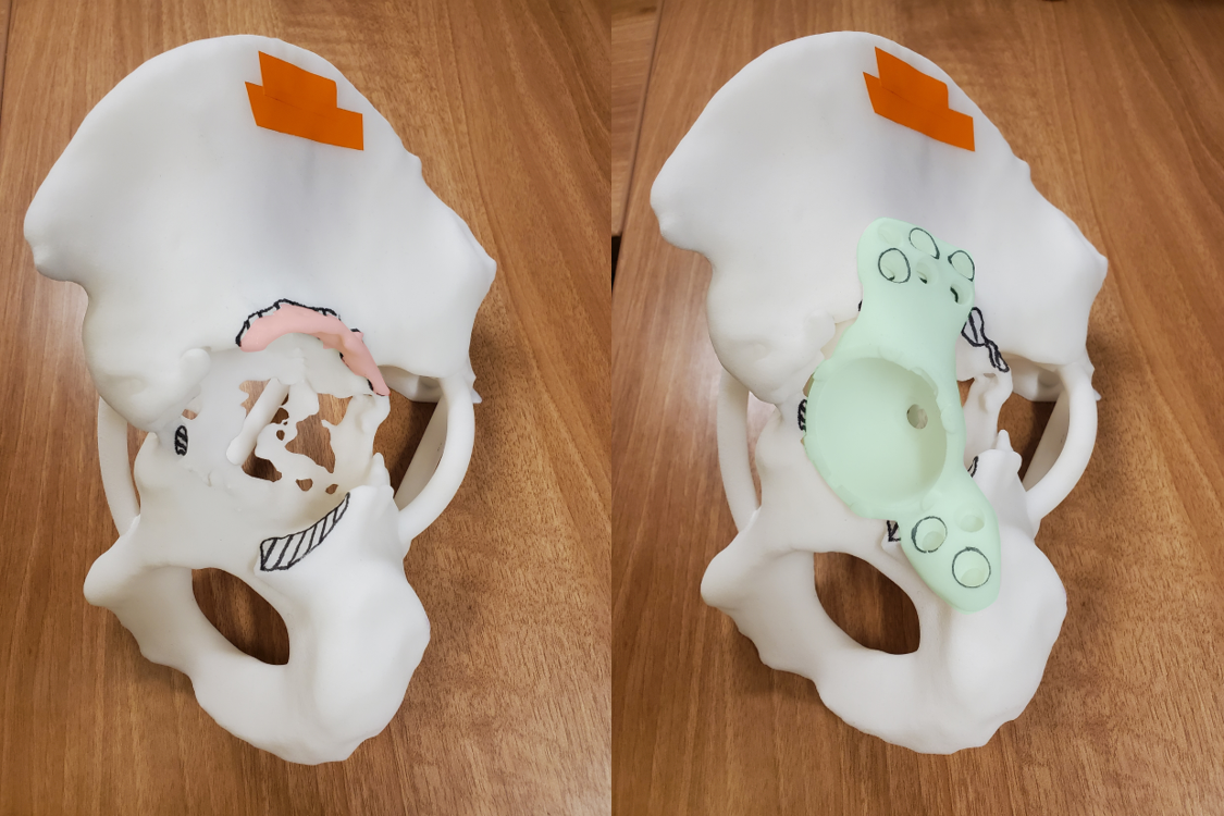 3D-printed plastic models help surgeons visualize and practice the surgical plan.