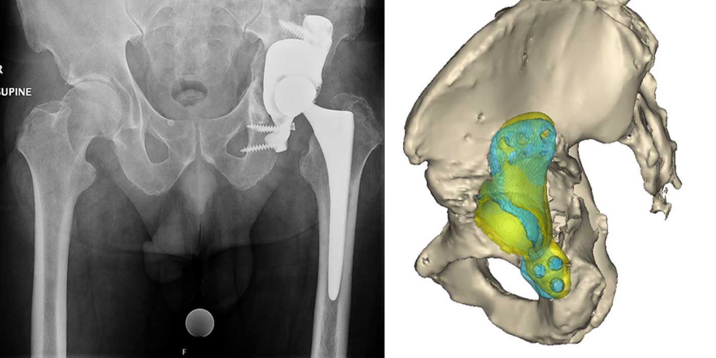 Post-operative images of the patient specific implant. A post-operative CT scan is used to compare the implanted position with the pre-operative plan.
