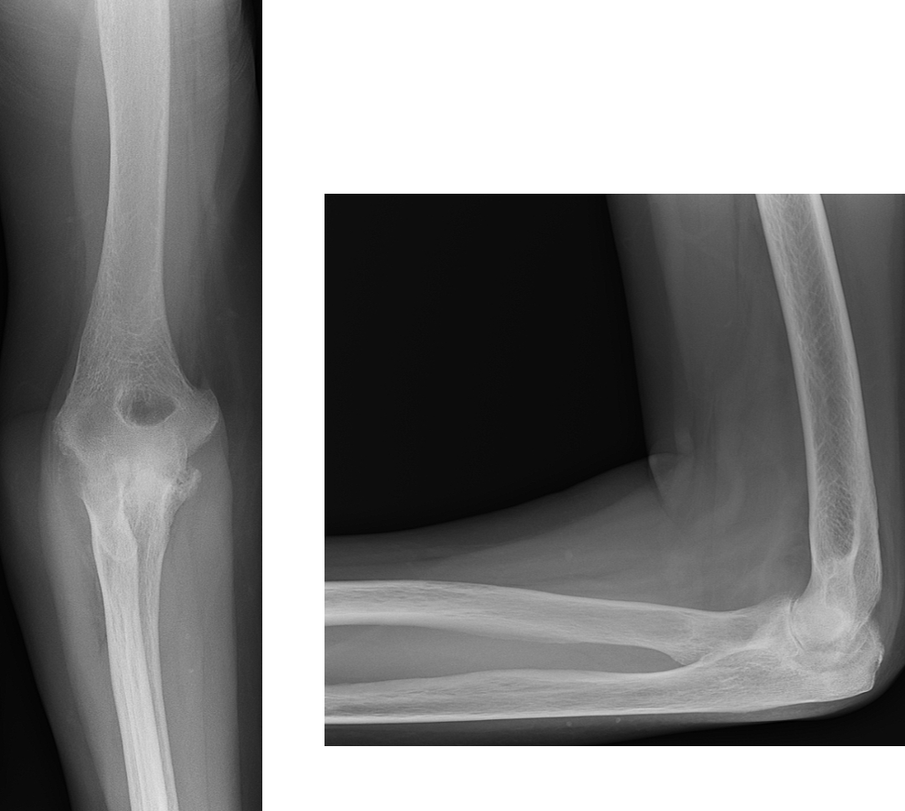 X-rays showing a right elbow of a patient with rheumatoid arthritis. Surgeon would like to perform cementless total elbow arthroplasty (TEA) on the patient.