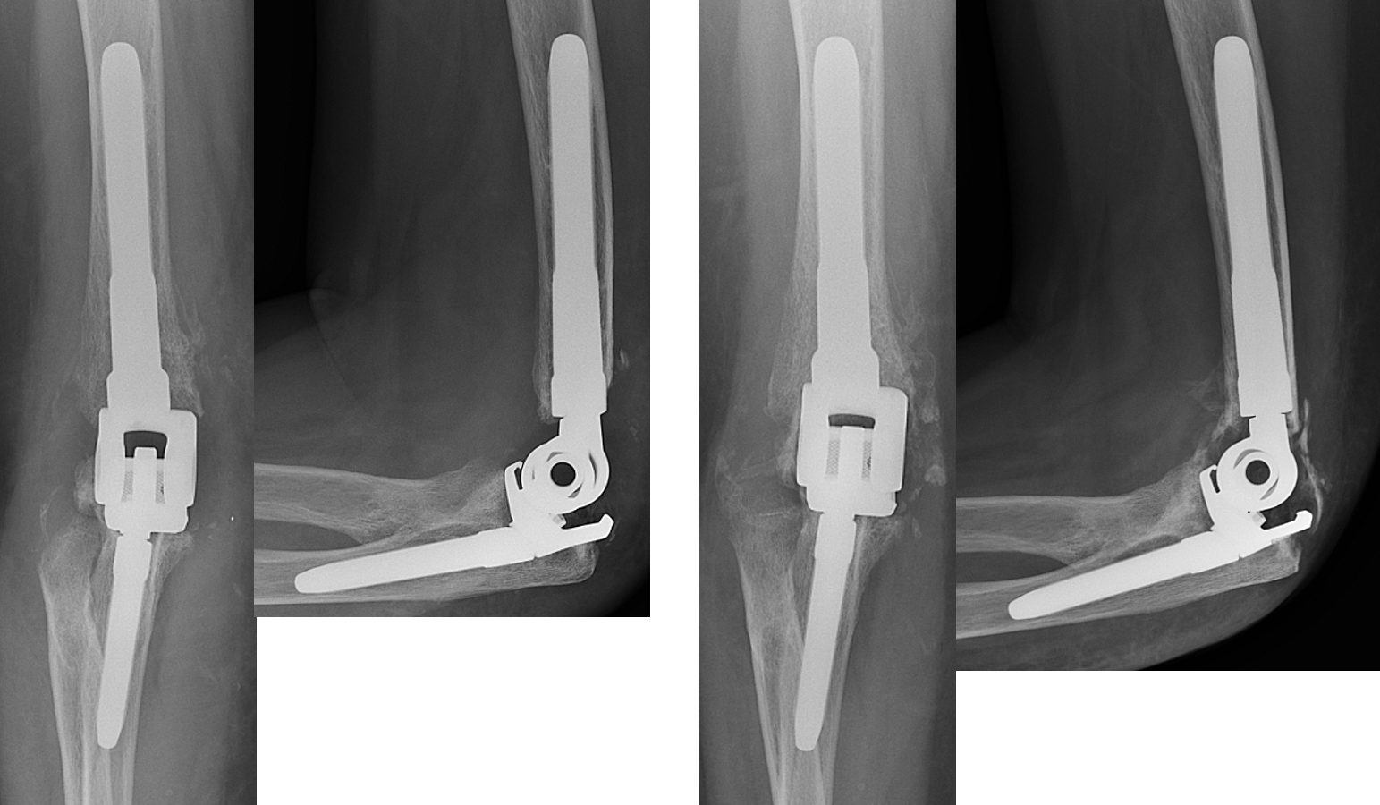 Immediate post-op x-rays (left) and 3-month post-op x-rays (right) showing well-fixed implants and bone ingrowth.   