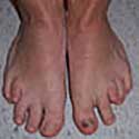 Foot and Ankle Deformities