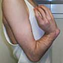 Upper Extremity Lengthening and Deformity Correction