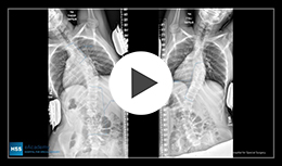 Image - Thumbnail for Posterior Spinal Fusion and Instrumentation for AIS