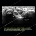 Image - Ultrasound of the Month Case 67 thumbnail