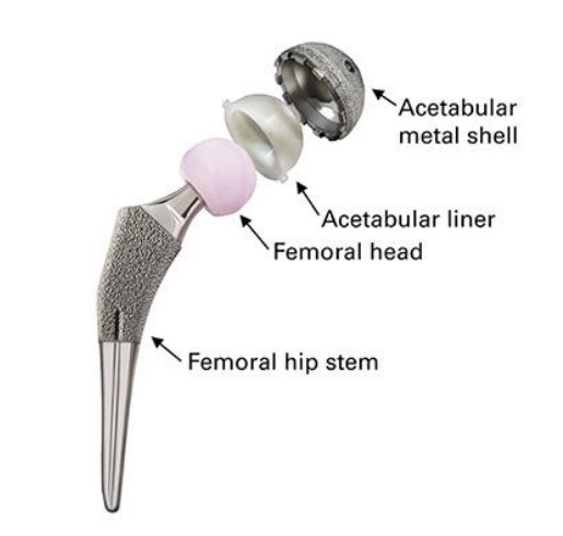 components of Exactech hip replacement