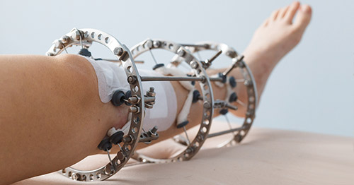 An Ilizarov limb lengthening external fixator attached to a patient receiving treatment.