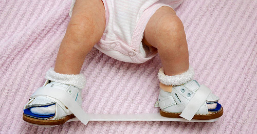 A Ponseti brace for maintenance of clubfoot correction.
