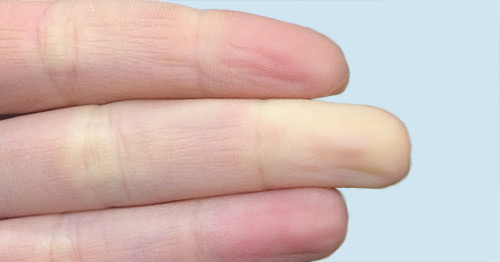 Close-up of fingers with Raynaud's discoloration.